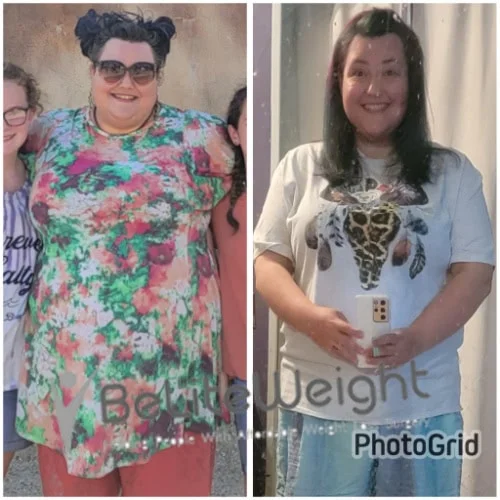 Weight Loss Surgery Gastric Sleeve before and after